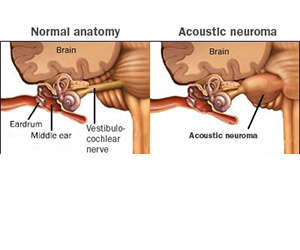 Acoustic Neuroma Tumors