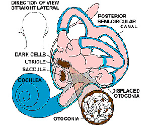 BPPV